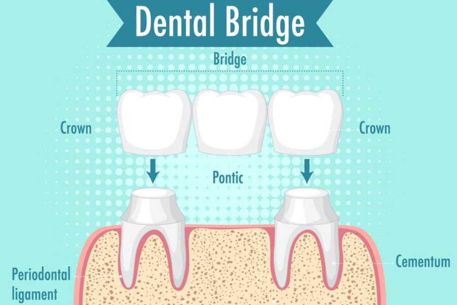 Dental bridges