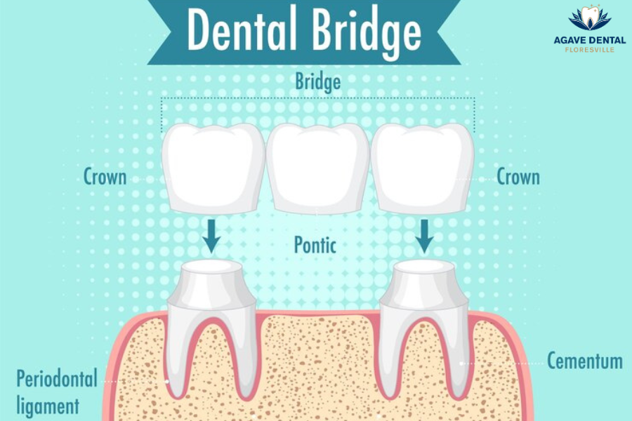 Dental bridges