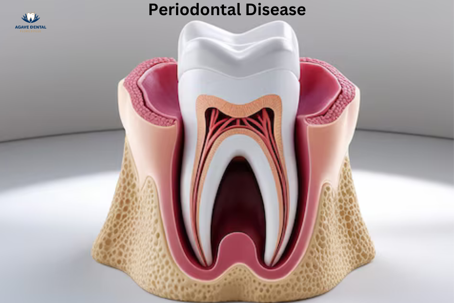 Periodontal Disease Treatment