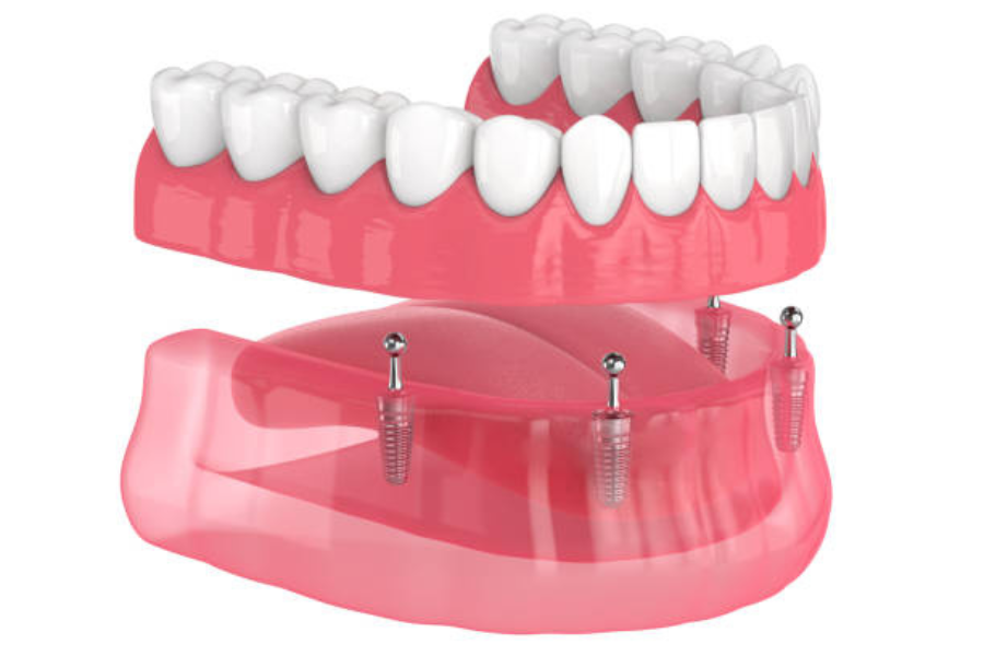 Partial dentures