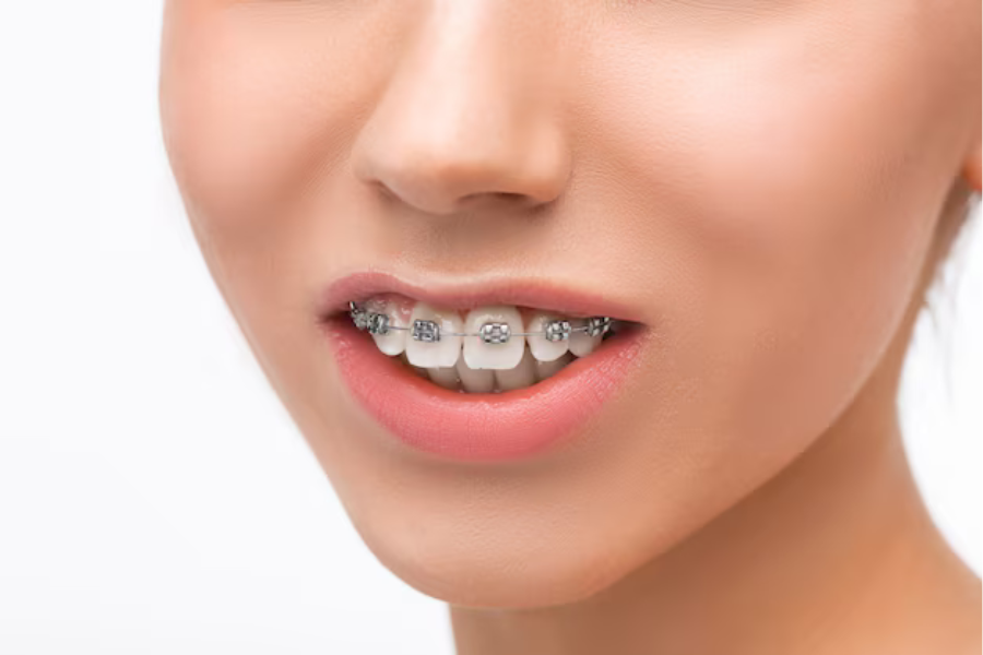 Dental Braces