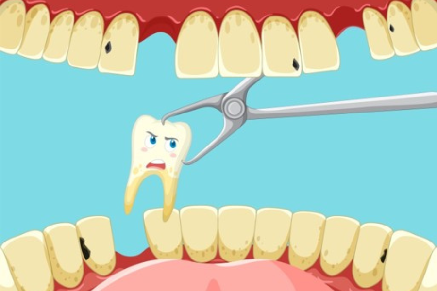 Tooth extraction