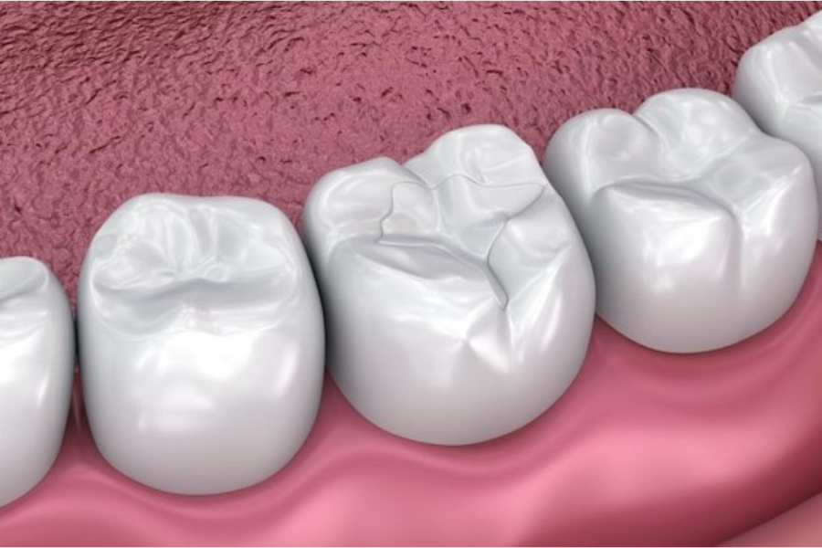 Dental sealants
