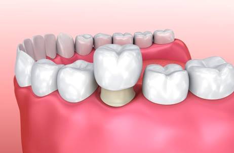 Can a Dental Crown Be Repaired or Replaced if It Breaks?