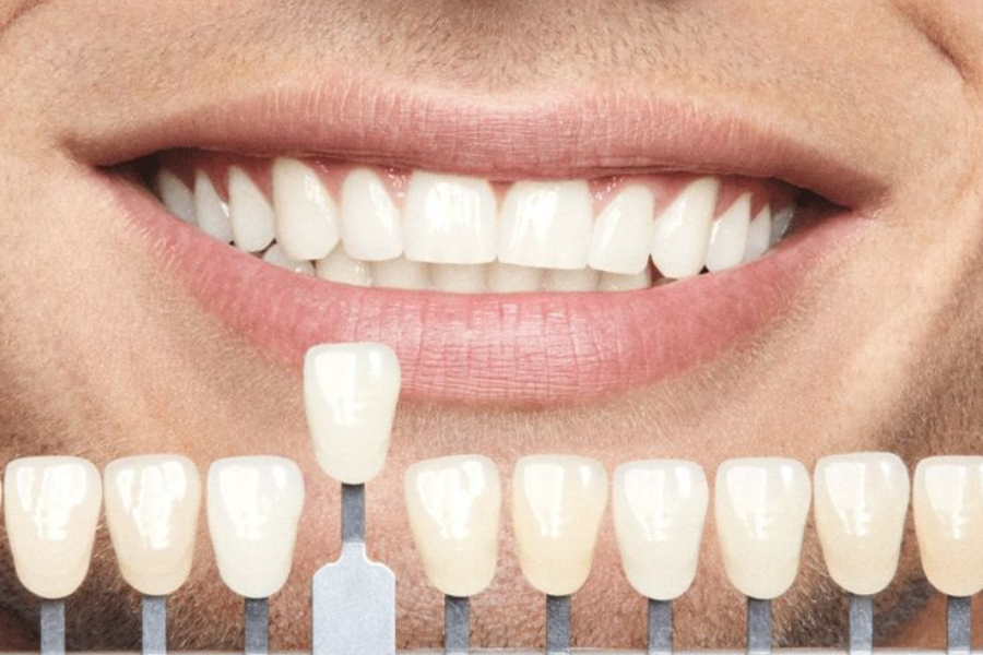Dental veneers