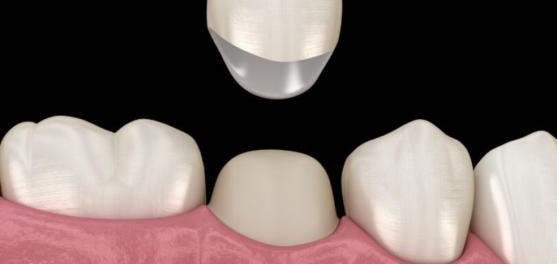 Dental Crowns