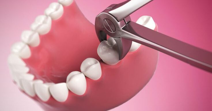 Tooth Extraction