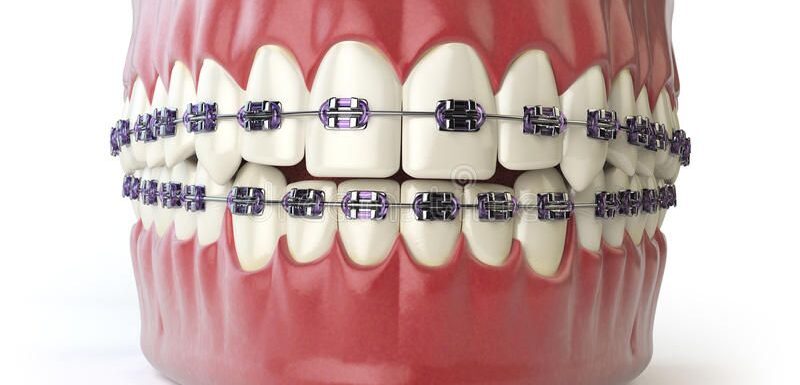 Dental Braces